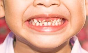 La carie dentaire chez les enfants : remèdes et préventions La-carie-dentaire-chez-les-enfants-735x400